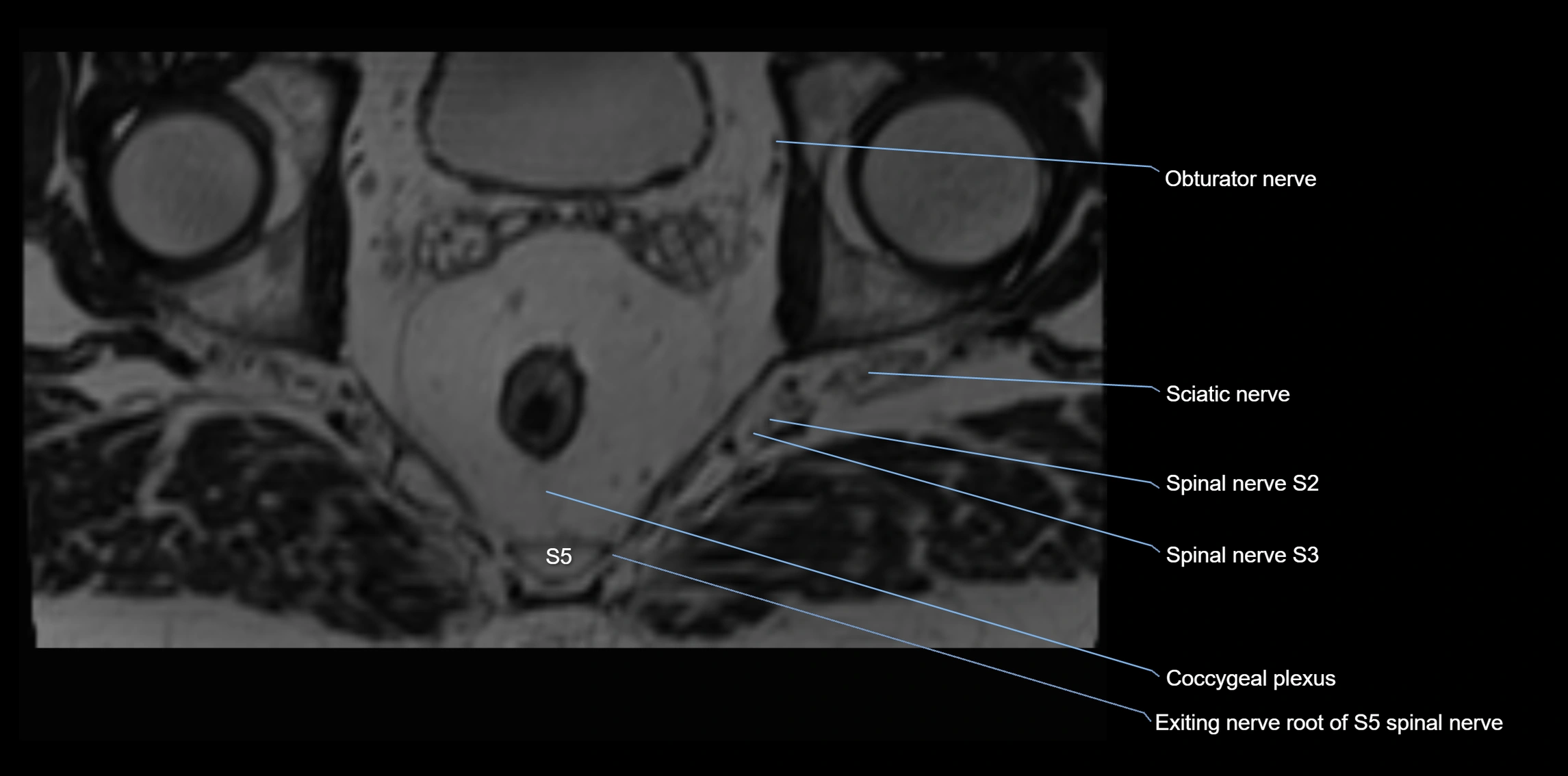MR lumbosacral plexus axial cross sectional anatomy 3T  radiology  image-img-1008001-00116.webp